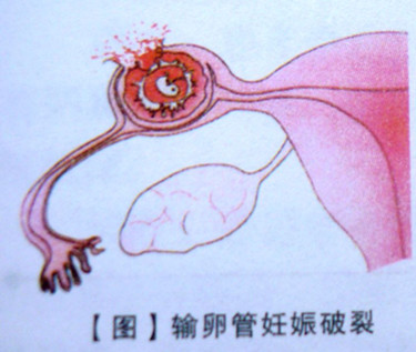 输卵管壶腹部妊娠破裂型