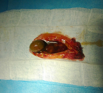 腹腔镜下妇科手术联合胆囊切除术