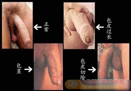 成都男人包茎过长手术图片是怎样的