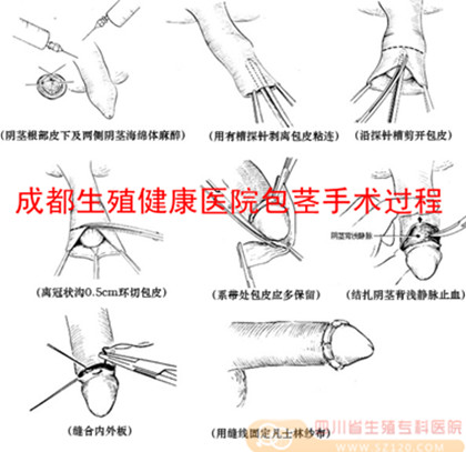 全国有三分之一的男性有包茎包皮过长的现象,了解到包茎包皮过长的