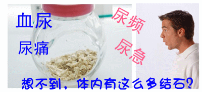 泌尿结石