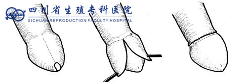 商环微创包皮环切术效果图
