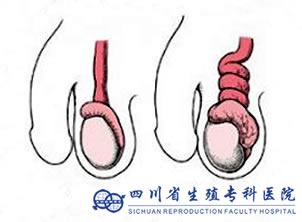 咨询专家:男性突发睾丸扭转该怎么办?