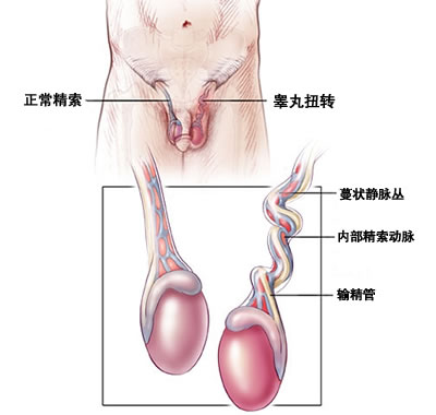 睾丸扭转该怎么办呢