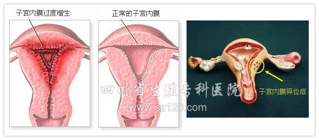 <a href='http://www.sz120.com/zgnmywz/zgnmywzdzl/22082/					' title='子宫内膜异位症' target='_blank'>子宫内膜异位症</a>