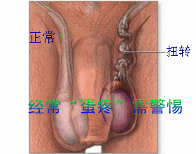 睾丸扭转