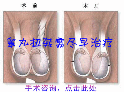 睾丸扭转手术