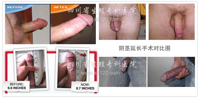 <a href='/szzx/yjyz/' title='阴茎延长' target='_blank'>阴茎延长</a>手术效果图